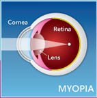 Myopia_img